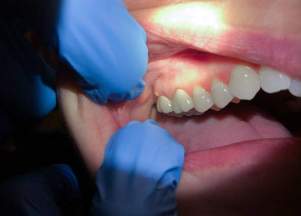 Best Dentist for Tooth Abscess  in Enfield, NC